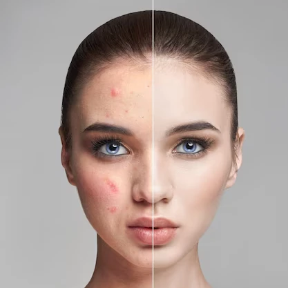 Photo Facial