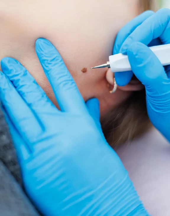 Birthmark Removal