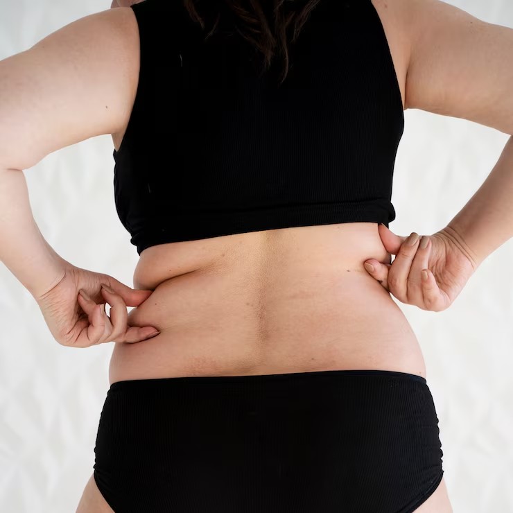 Cellulite Removal