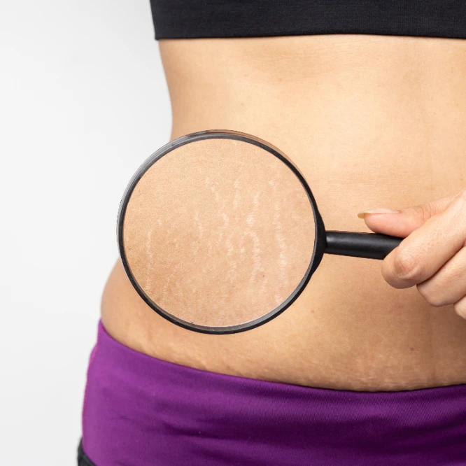 Stretch Marks Reduction