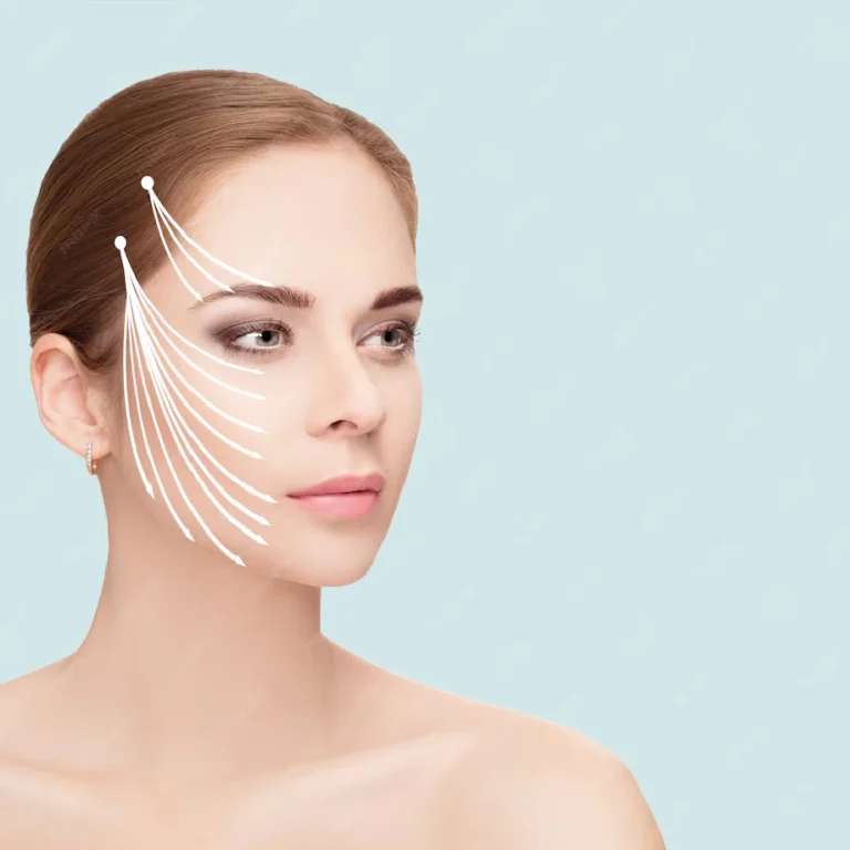 Thread Lift