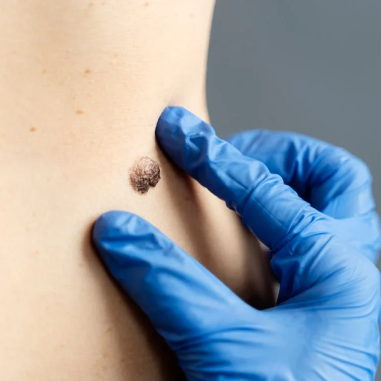 Wart Removal