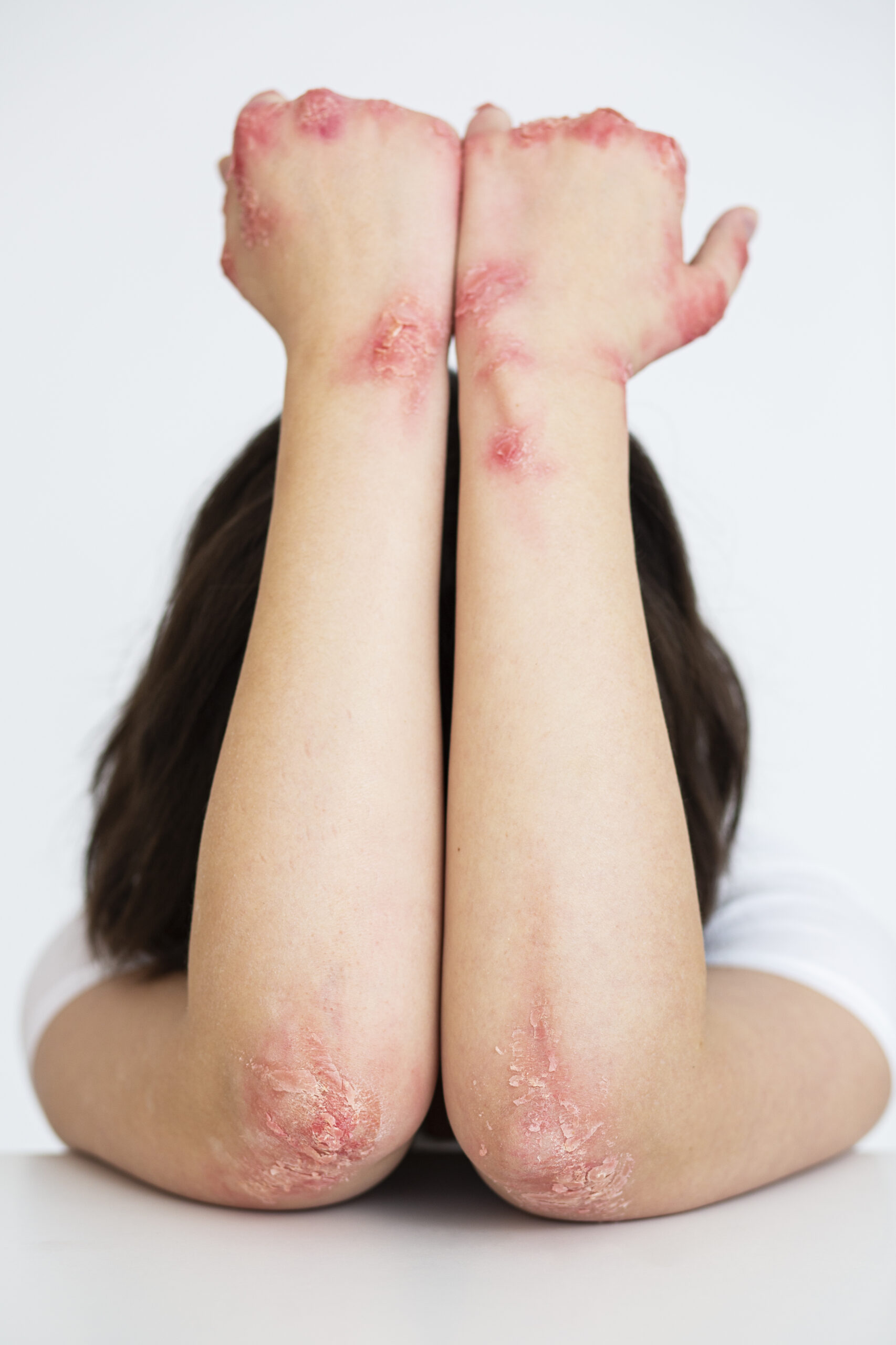 Seborrheic Dermatitis