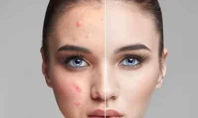 Photo Facial